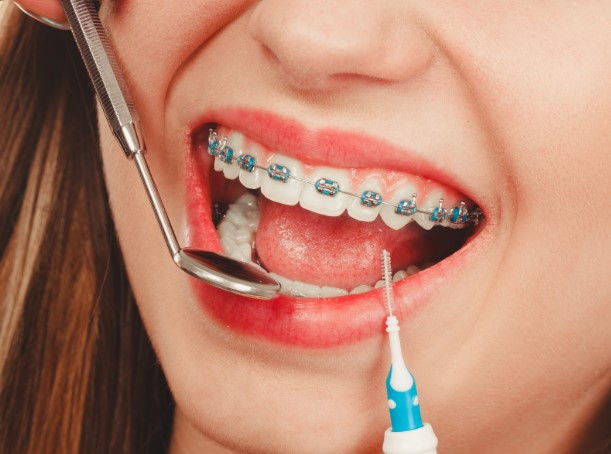 скільки коштує встановити брекети для дорослих