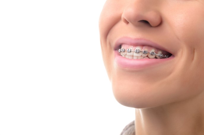 яка ціна брекетів для підлітків у 2024 році